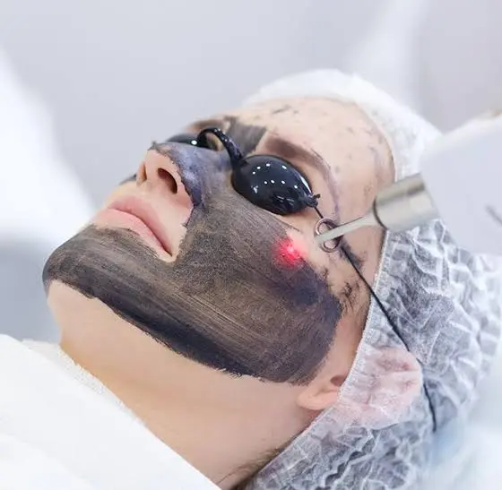 Is Laser Carbon Peel Suitable for Dull Skin