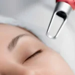 Is Pico Laser Treatment Suitable for Melasma