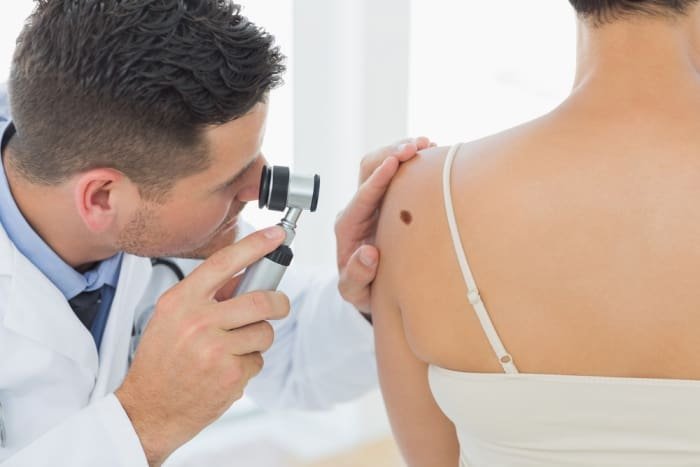 Moles-and-melanoma-a-mole-examination