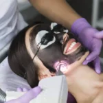 What Can Laser Carbon Peel Do for Acne