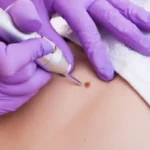 What Can Skin Lesion Removal Treat on Skin