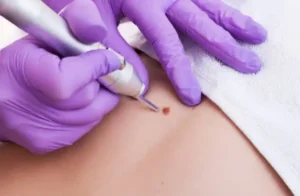 What Can Skin Lesion Removal Treat on Skin