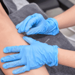 dry needling physiotherapy