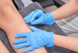 dry needling physiotherapy