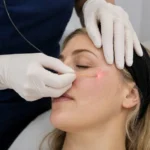 What Makes Endolift Effective for Skin?