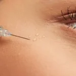 What Makes Under Eye Fillers Reduce Hollow Eyes