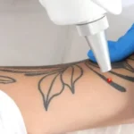 What Should You Expect From Laser Tattoo Removal
