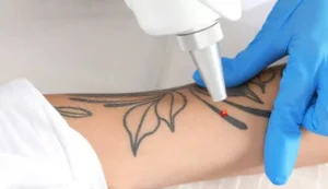 What Should You Expect From Laser Tattoo Removal