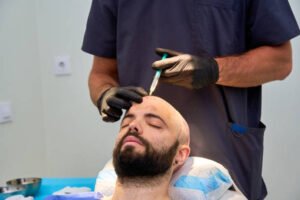 What are the key stages of FUE Hair Transplant recovery