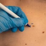 What are the key stages of Skin Lesion Removal treatment