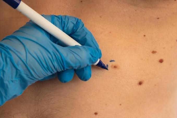 What are the key stages of Skin Lesion Removal treatment