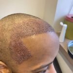 What techniques are used in modern Hair Transplant procedures