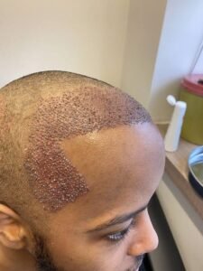 What techniques are used in modern Hair Transplant procedures