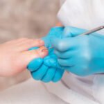 ingrown toenail treatment