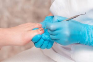 ingrown toenail treatment