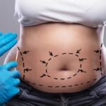 Tummy Tuck Dubai: How to Maintain Results After Surgery