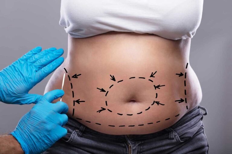 Tummy Tuck Dubai: How to Maintain Results After Surgery